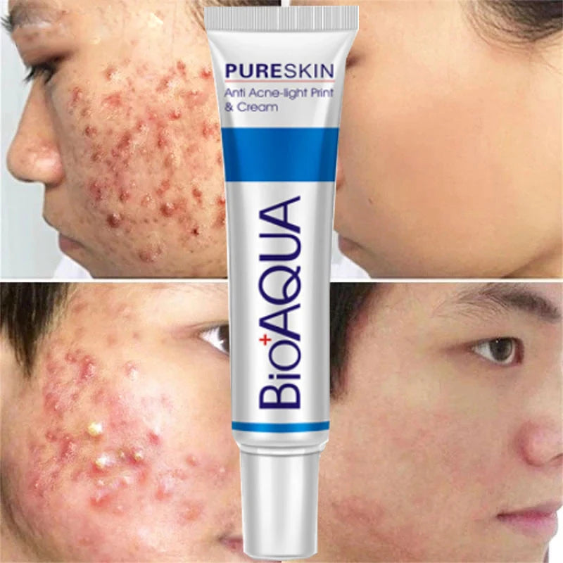 BIOAQUA Anti Acne Cream Acne Scar Removal Cream