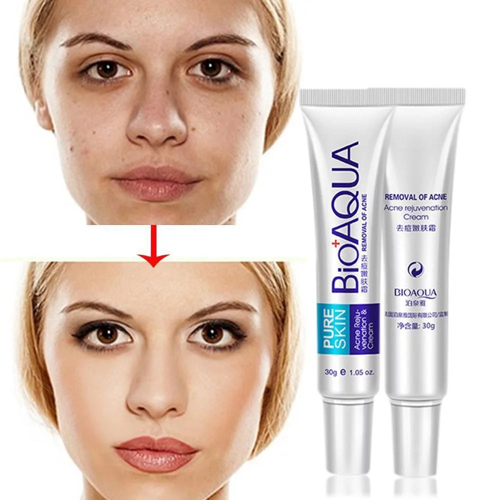 BIOAQUA Anti Acne Cream Acne Scar Removal Cream